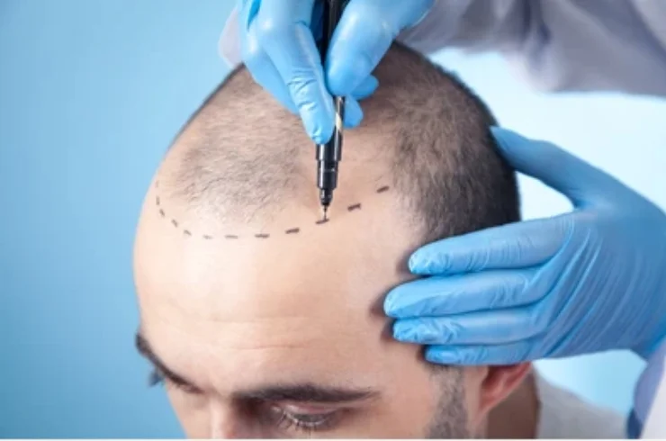 Hair Transplant-