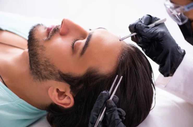 Hair Transplant-