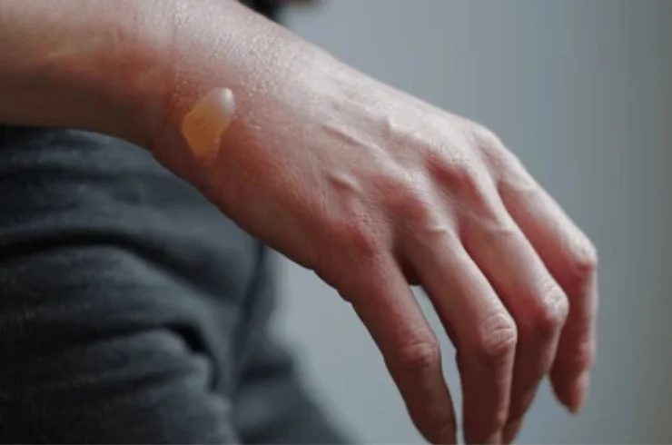 Burns & Burn Contractures------1