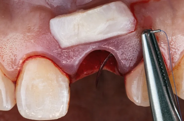 Flap Surgeries------1