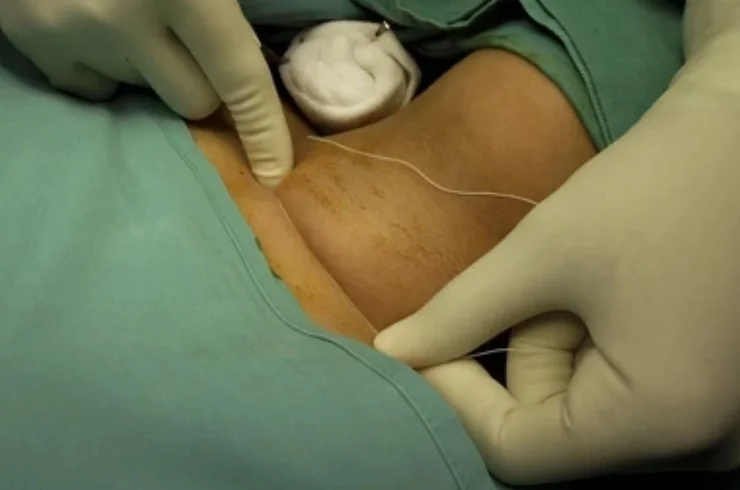 Flap Surgeries------3