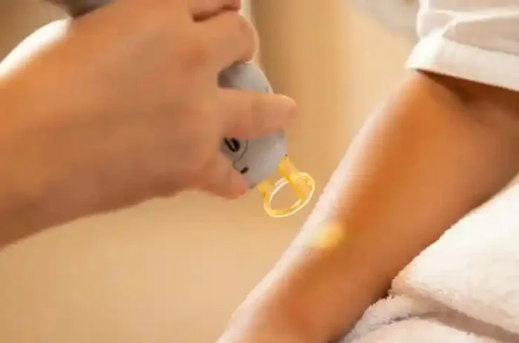 LASER HAIR REMOVAL-------2