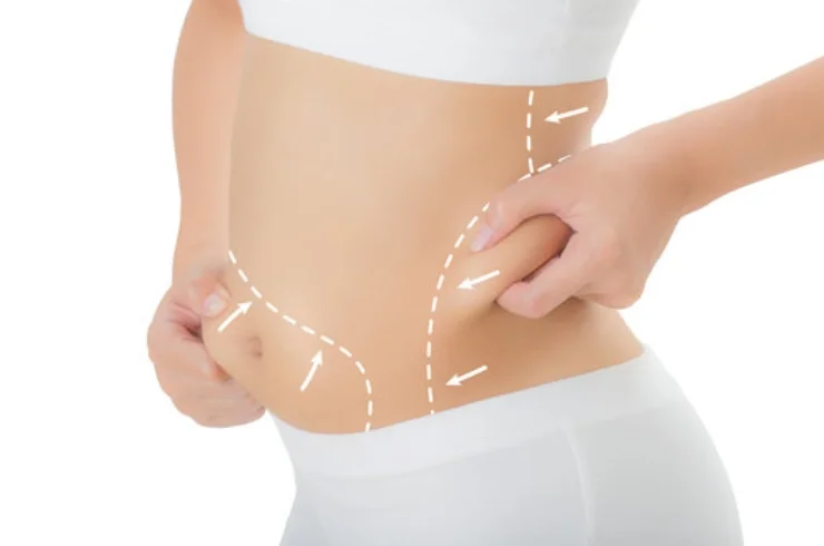 LIPOSUCTION-------1