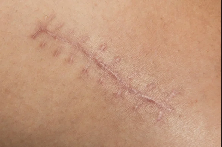 SCAR MODIFICATION-----1