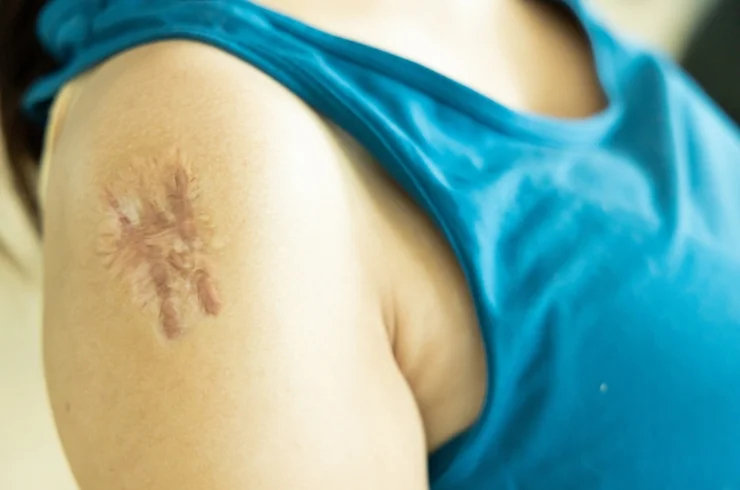 SCAR MODIFICATION-----2