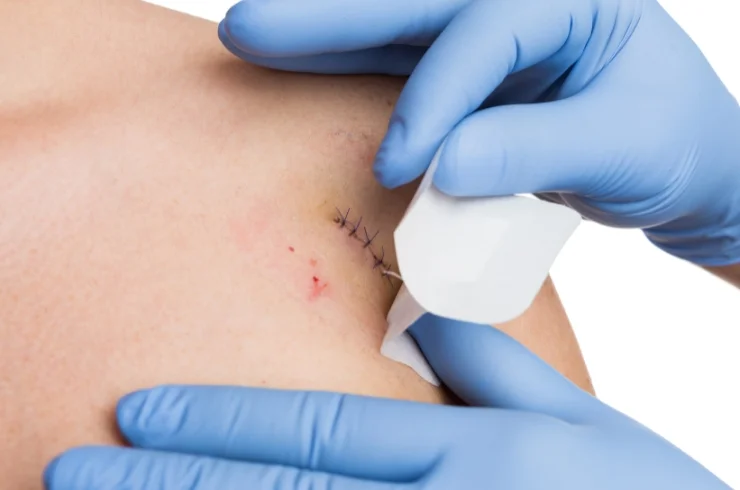 SCAR MODIFICATION-----3