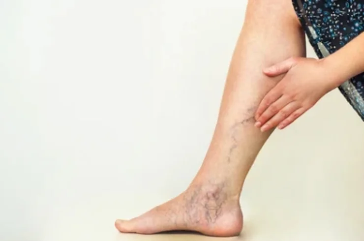 VARICOSE VEINS