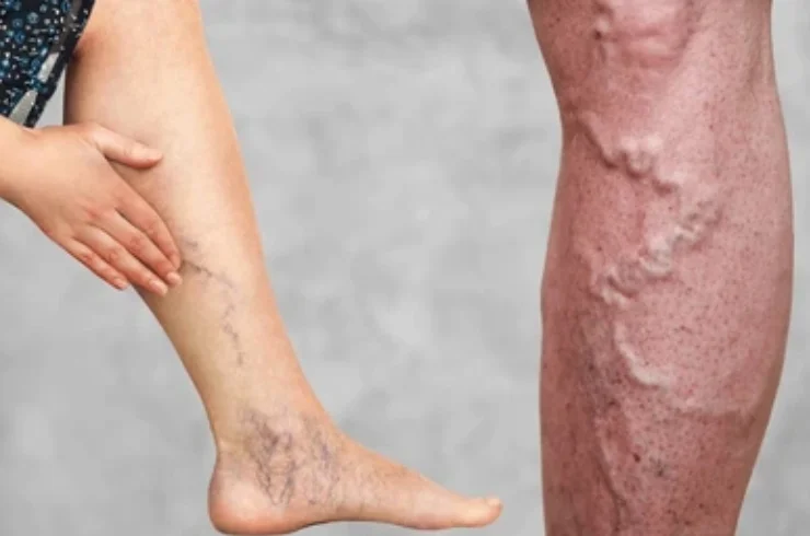 VARICOSE VEINS